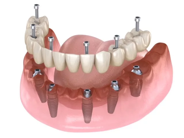 mandibular prosthesis all on 4 system supported by implants, screw fixation. medically accurate 3d illustration of dental concept